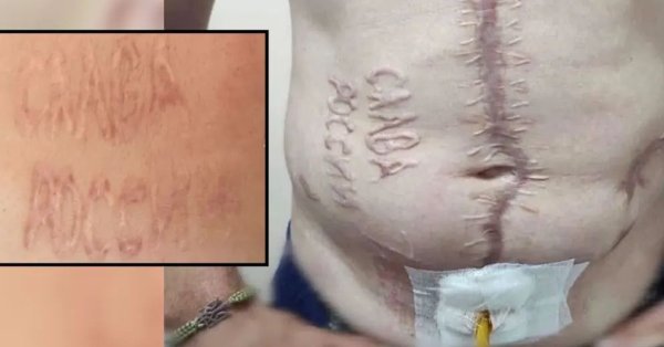 Врачи борются с надписью «Слава России», вырезанную в живот украинского, чтобы исчезнуть