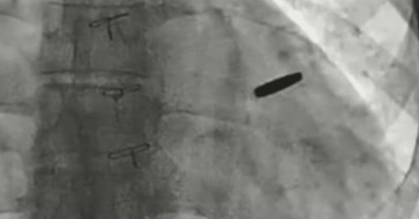 Солдат, защищая Азовстала, провел три года в российском плену с пулей в сердце видео