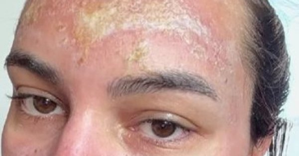 Салон, где женщина получила ожоги второй степени от пилинта, остался незарегистрированным