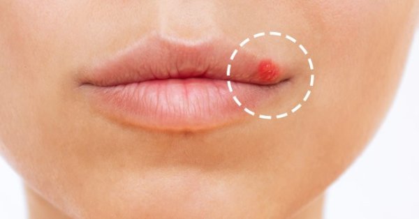 Советы, как успокоить герпес