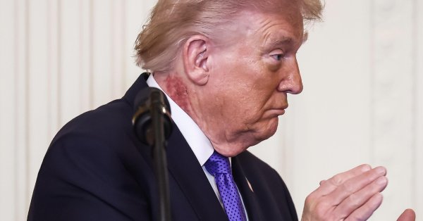 Трамп находится в реанимации из-за сыпи на шее